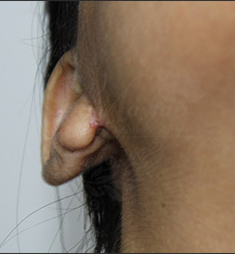 After-TransformationTuesday-Ear-lobe-1