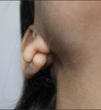 Before-TransformationTuesday-Ear-lobe-1