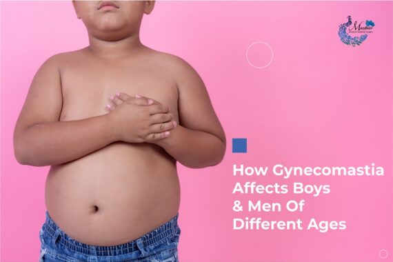 How Gynecomastia Affects Boys And Men Of Different Ages
